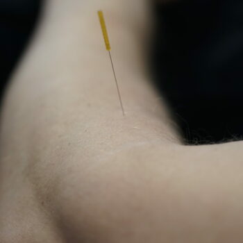 Behandeling met dry needling